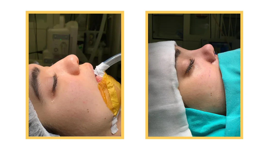 Qunomedical Patientin Fereba während ihrer Nasen OP