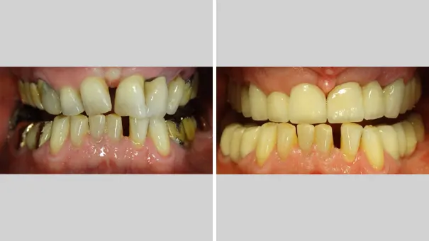 Patient showing their teeth before and after having all-metal dental crowns fitted.