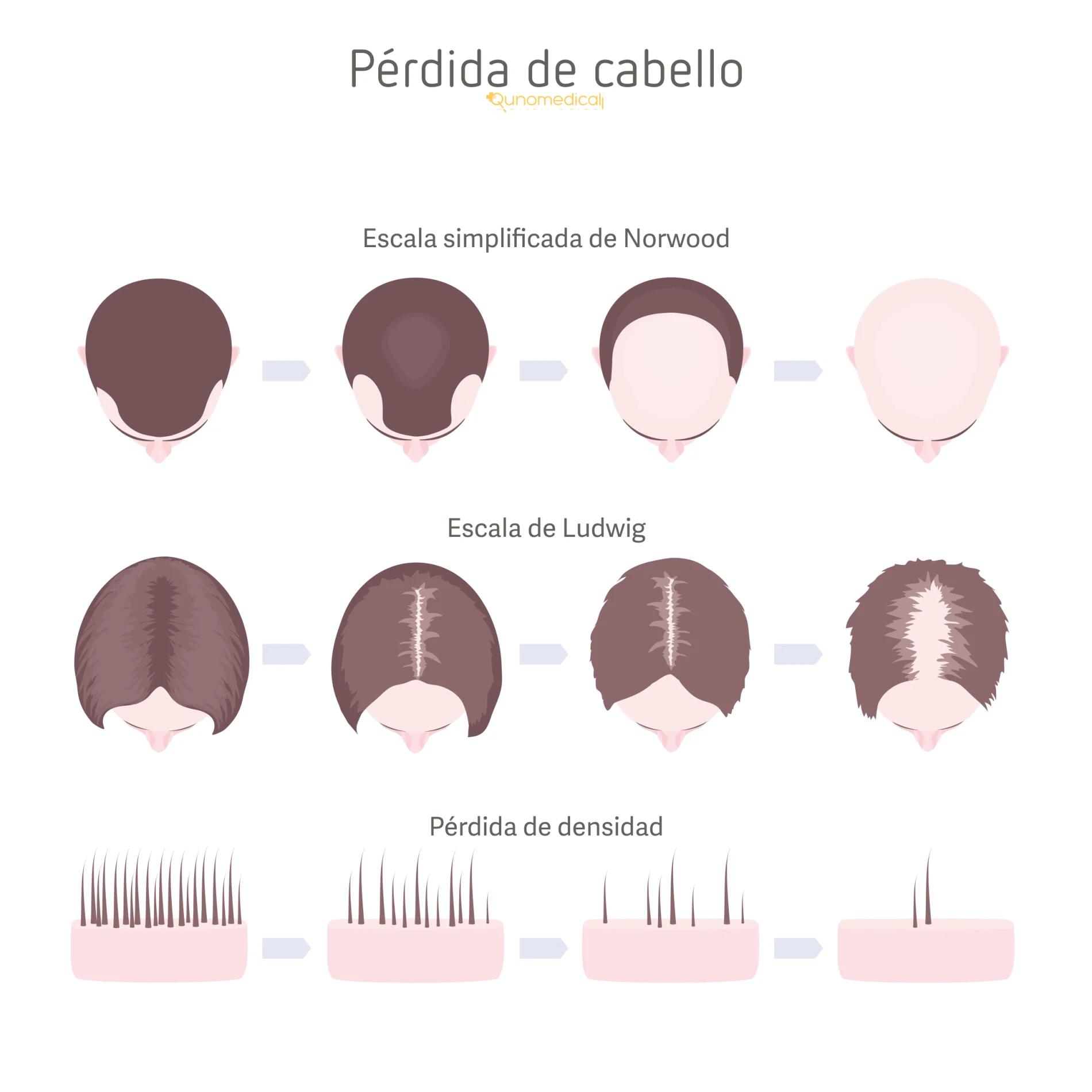 Ilustración que muestra los diferentes tipos de pérdida de cabello en la mujer.