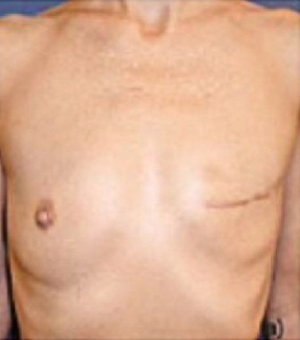 Back fat or migrated breast tissue? 34E - Fantasie » Costa Rica