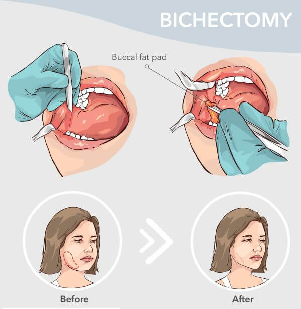 buccal-fat-removal-cheek-contour-enhancement-or-dangerous-trend