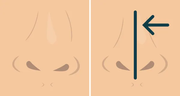 Before and after illustration of a post-traumatic rhinoplasty.