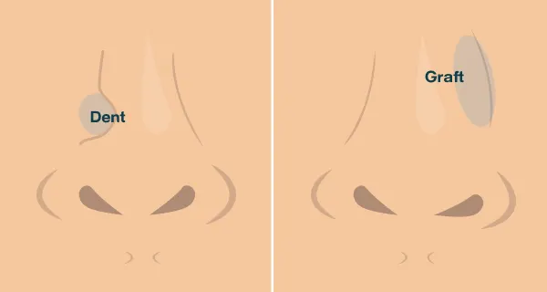 Before and after illustration of a reconstructive rhinoplasty.