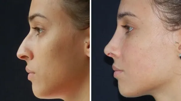 Before and after image of Dr. Tonic rhinoplasty