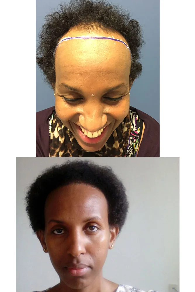 Trasplantes de pelo y pelo afro: opciones de cirugía 