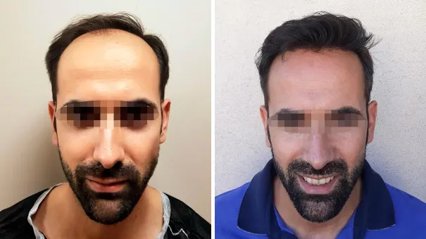 Mann lächelt und zeigt seine Haare vor und nach einer DHI Haartransplantation.