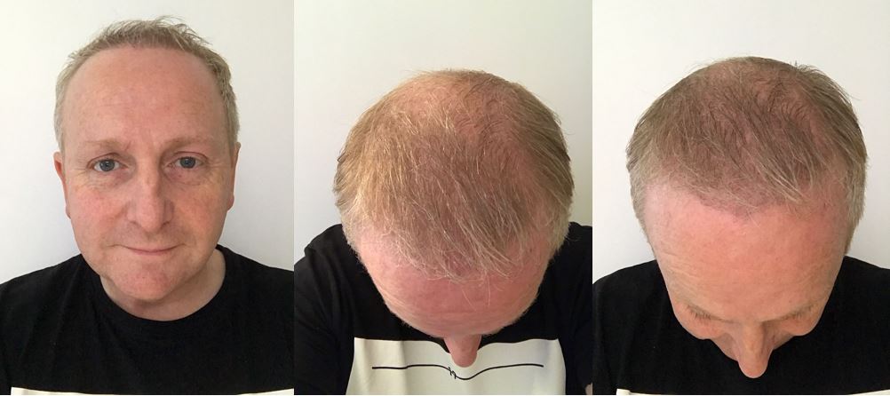 patient stories eamon s hair transplant 3 months later qunomedical