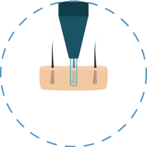  Illustratie die de eerste stap van de DHI haartransplantatie procedure laat zien.
