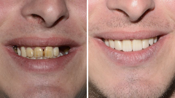 Mann lächelt und zeigt seine Zähne vor und nach einer Zahnimplantat-Behandlung.