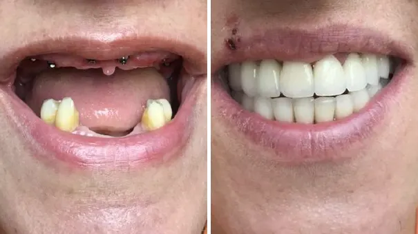 Woman smiling and showing teeth before and after having all-on-6 dental implants fitted.