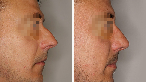 Man facing sideways to show the shape of his nose before and after undergoing rhinoplasty surgery.