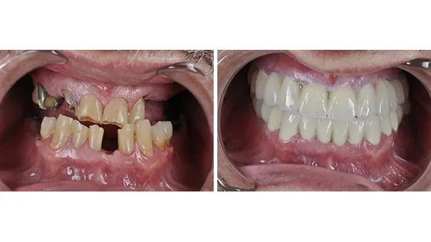 Patient showing their teeth before and after having ceramic-metal dental crowns fitted.