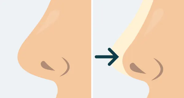Before and after illustration of a reduction rhinoplasty.