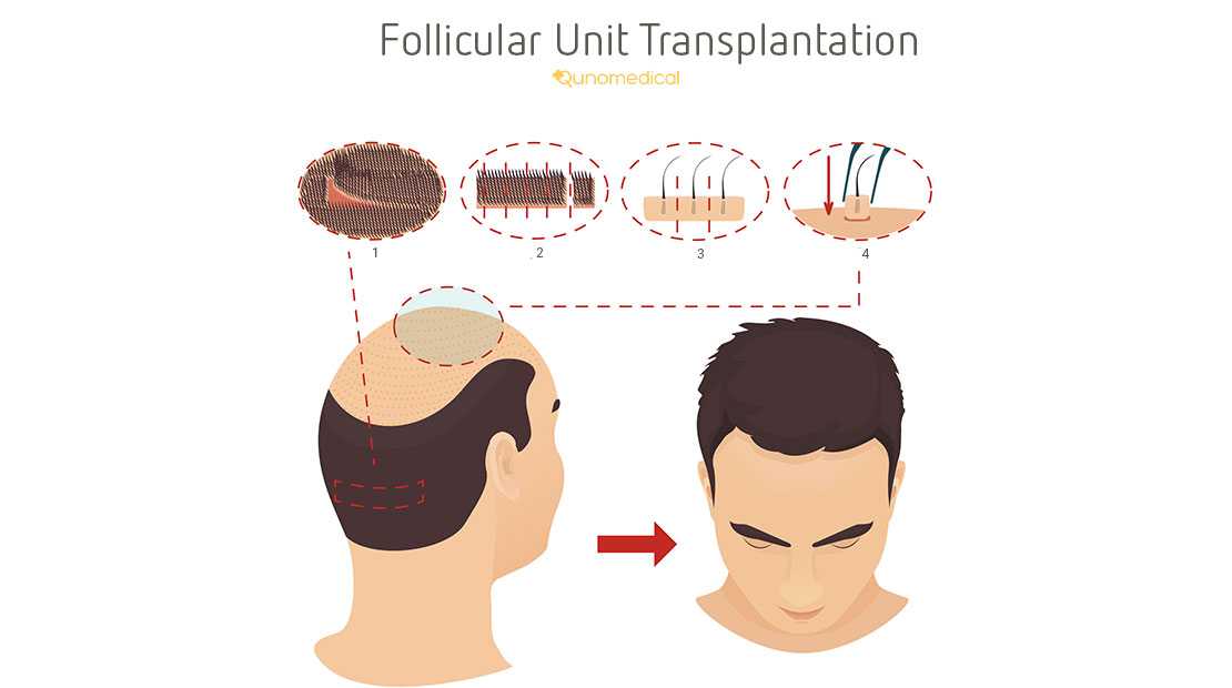 Fut Hair Transplant Qunomedical