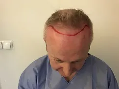 Image4_Eamon’s Hair Transplant Journey - Part II: During Treatment