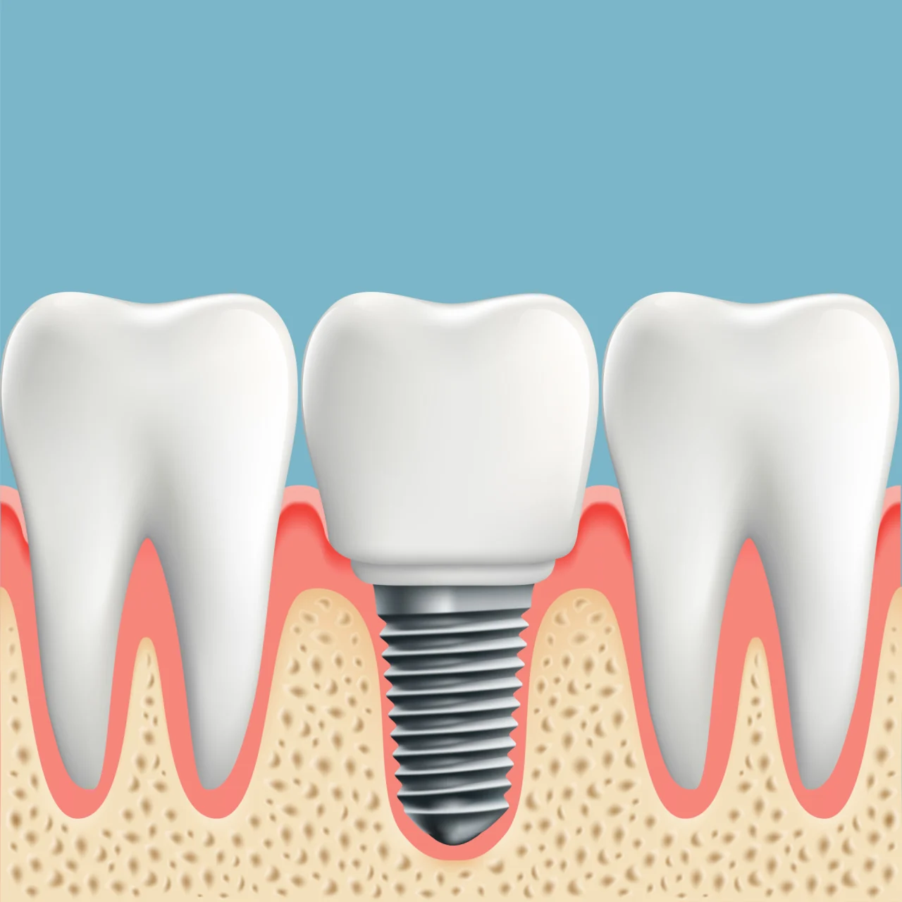 Guide für Zahnimplantate