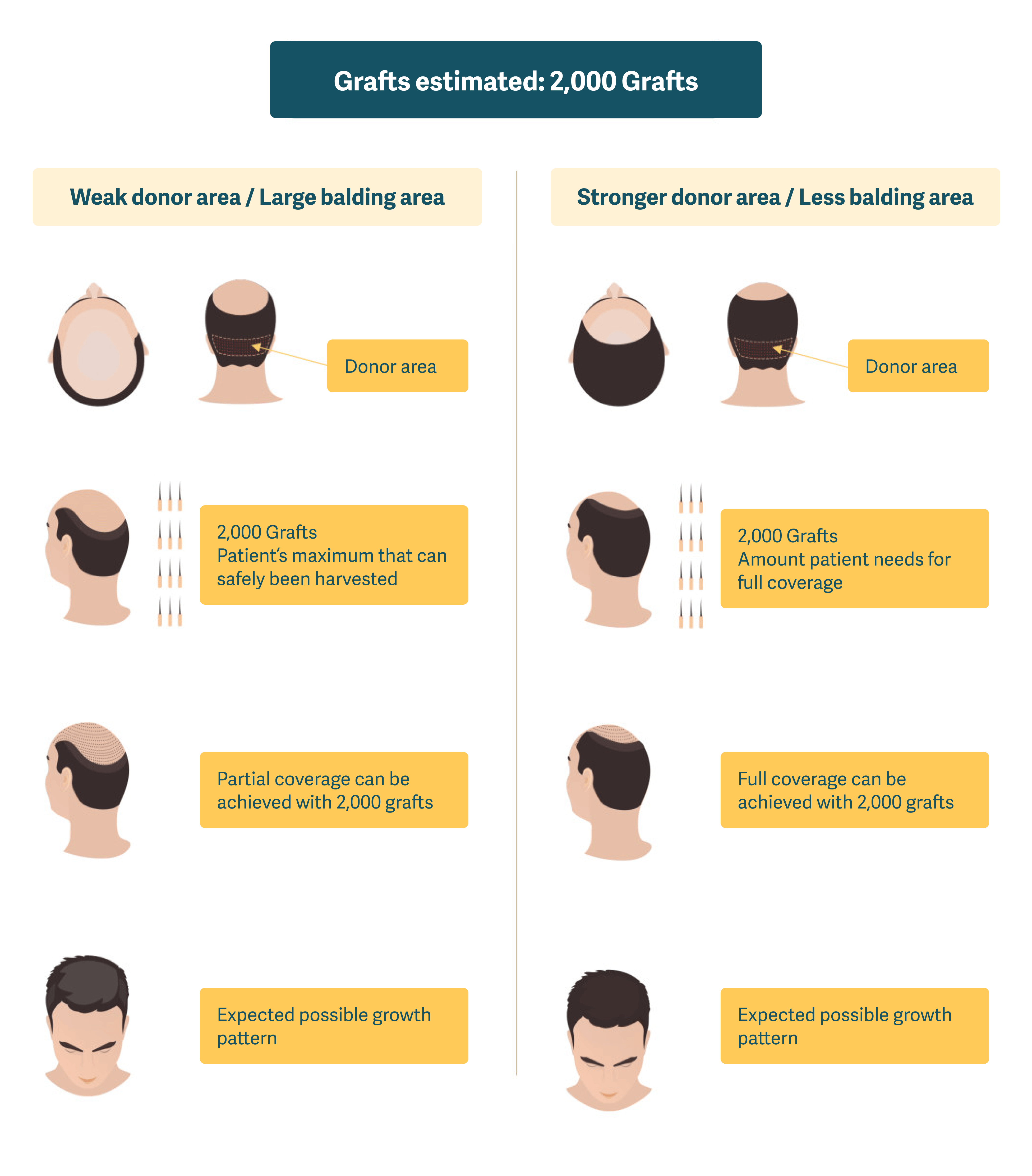 Full Hair Transplants and Complete Coverage | Qunomedical