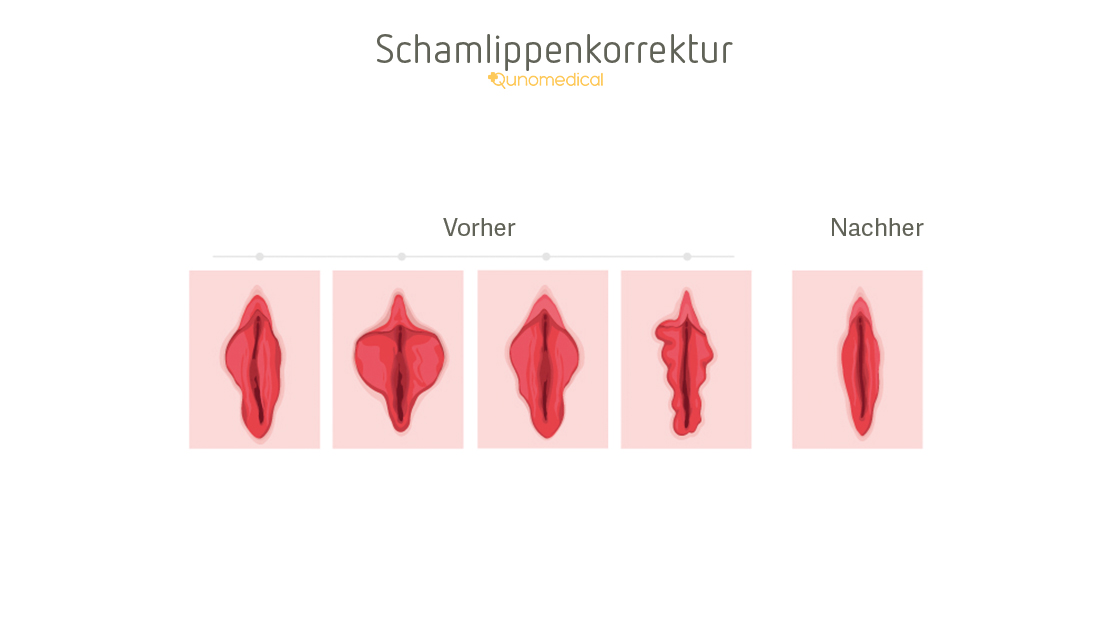 Vorhaut zuviel Mit Vorhaut