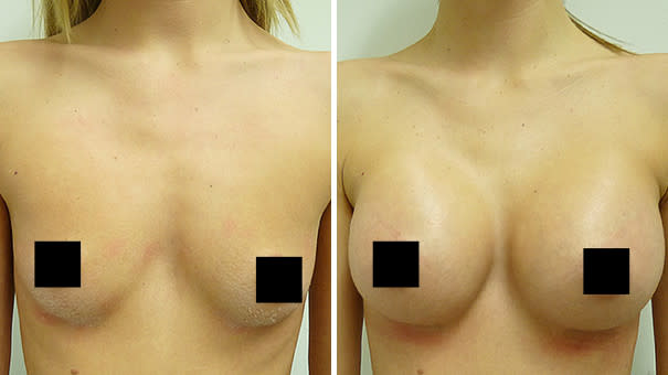 Image showing woman's breasts before and after undergoing breast implant surgery.