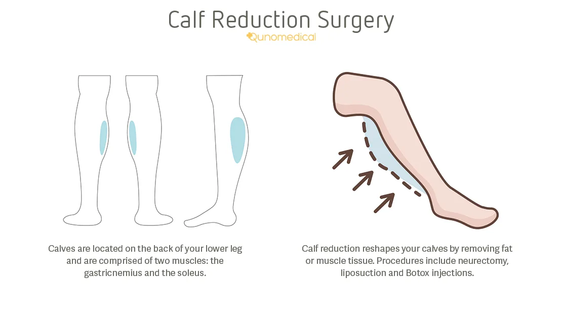 Calf Reduction Pros & Cons of Selective Neurectomy Qunomedical