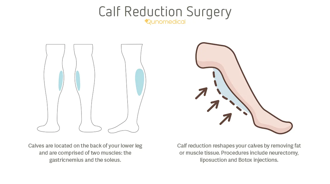 Image1_Calf Reduction: Pros & Cons of Selective Neurectomy