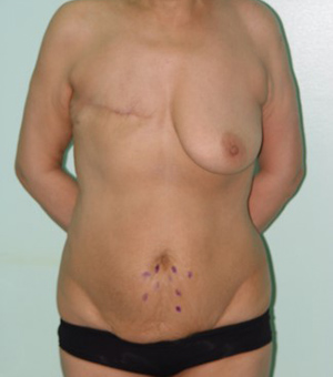 Back fat or migrated breast tissue? 34E - Fantasie » Costa Rica
