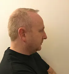 Image2_Eamon’s Hair Transplant Journey - Part I: Before Treatment