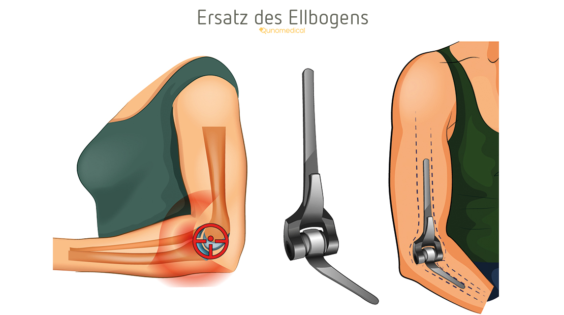 Ellbogengelenkersatzoperationen | Qunomedical