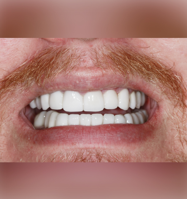 Matériau de la couronne temporaire de soins dentaires pour les molaires de  placage antérieure - Chine Modèle de soins dentaires Soins dentaires,  Turbine dentaire
