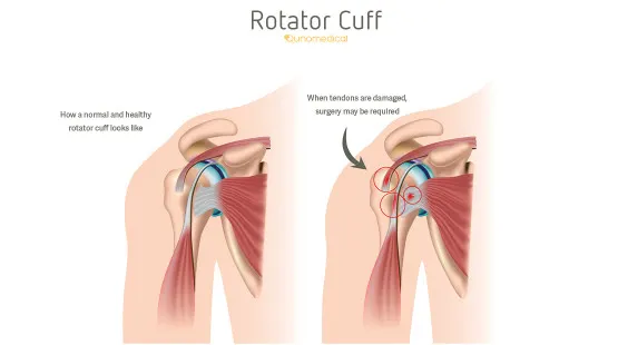 Illustration showing the difference between a healthy and damaged rotator cuff.