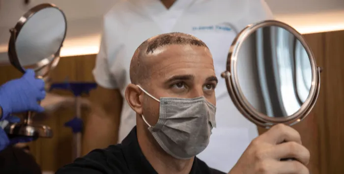 hair transplant patient checking the transplanted area