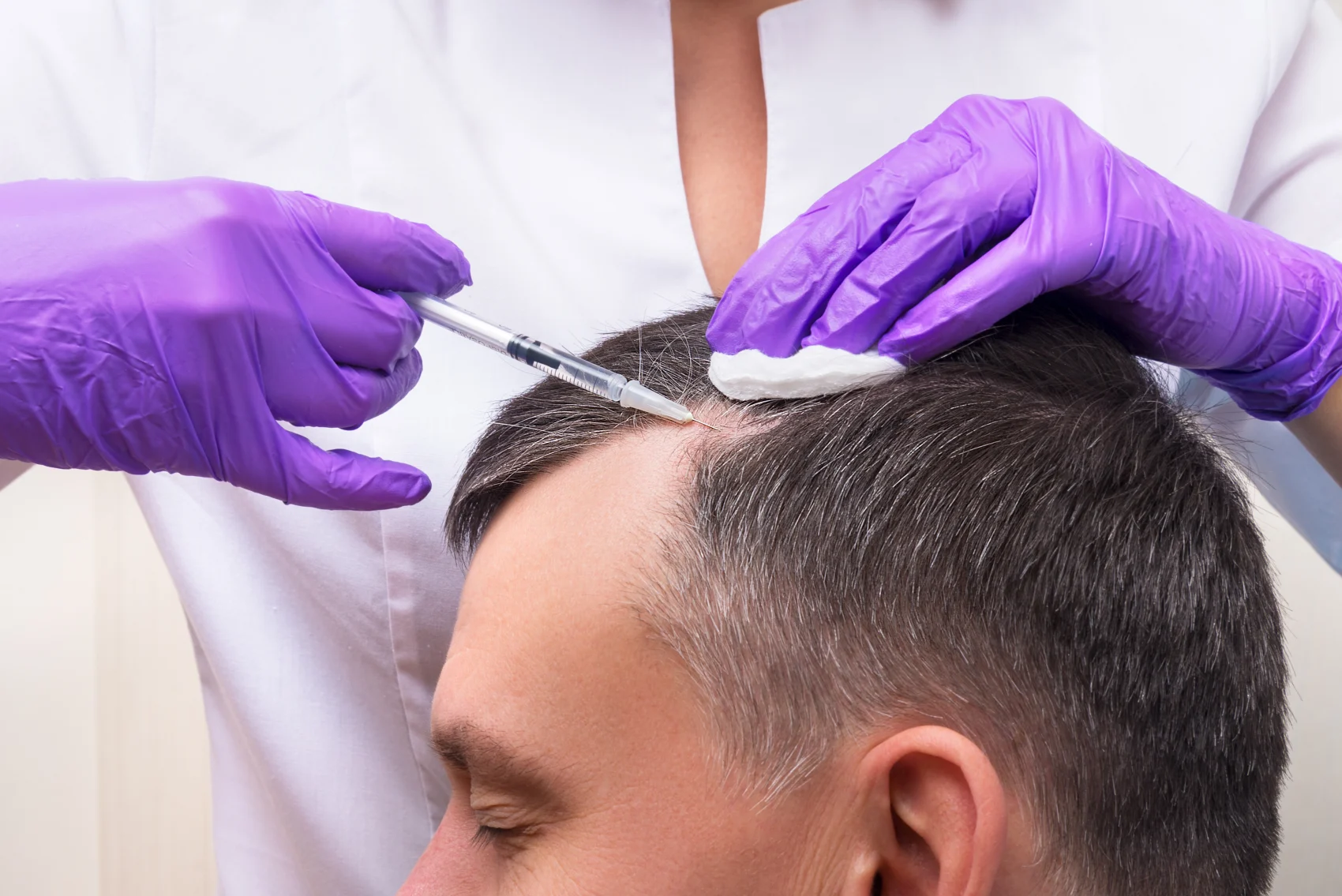 Man getting PRP therapy done on his balding head