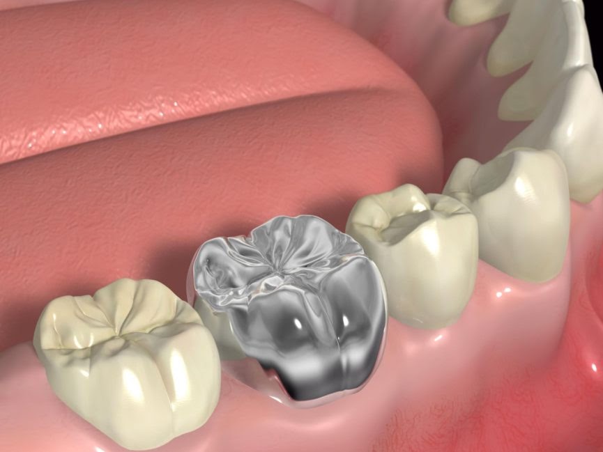 Image showing look and placement of a metal dental crown.