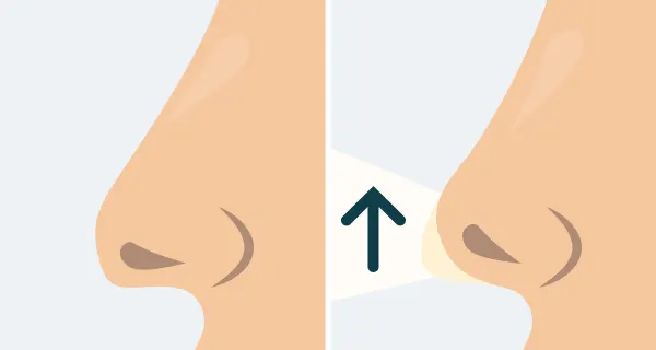 Before and after illustration of a refinement rhinoplasty.