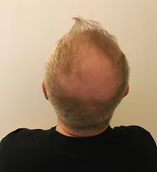 Image3_Eamon’s Hair Transplant Journey - Part I: Before Treatment