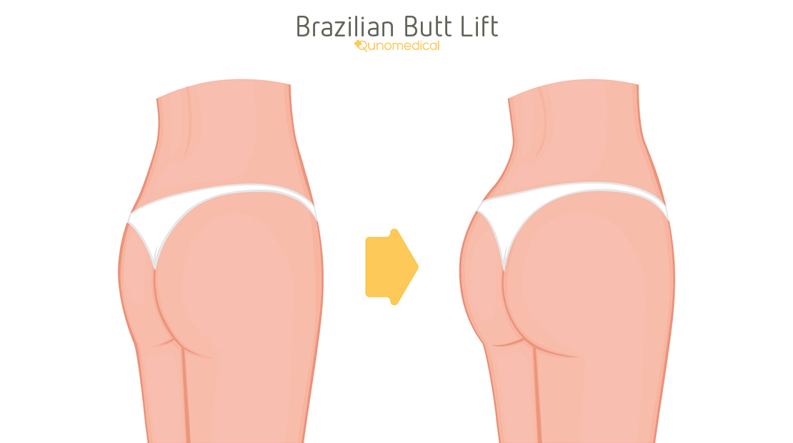 how long does brazilian butt lift last