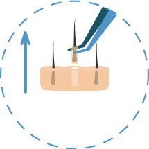 Illustration showing the second step of the FUE hair transplant procedure.