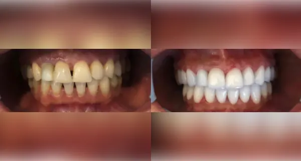 Woman smiling to show her teeth before and after having veneers fitted.