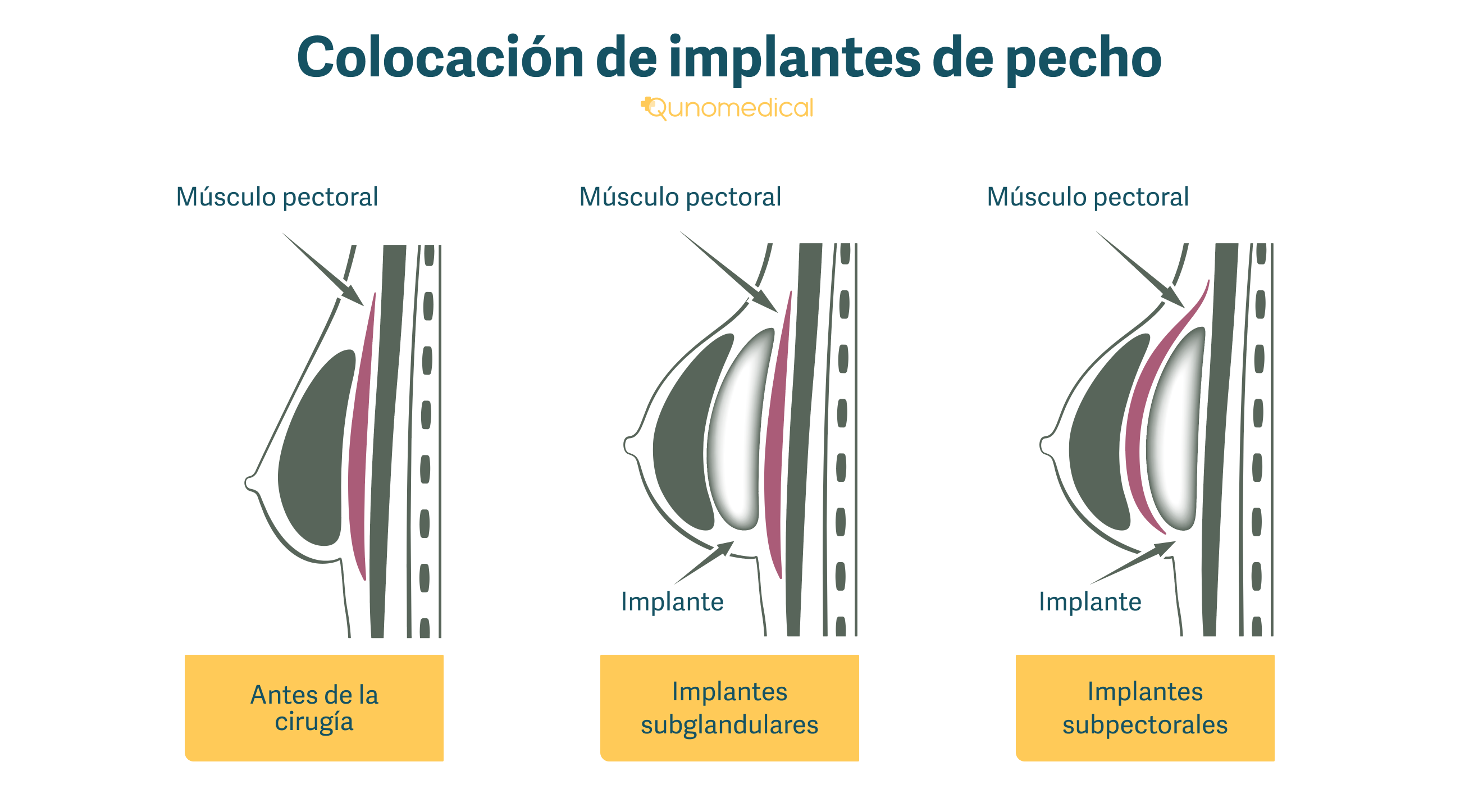 Cirugía de Implantes de Pecho | Qunomedical