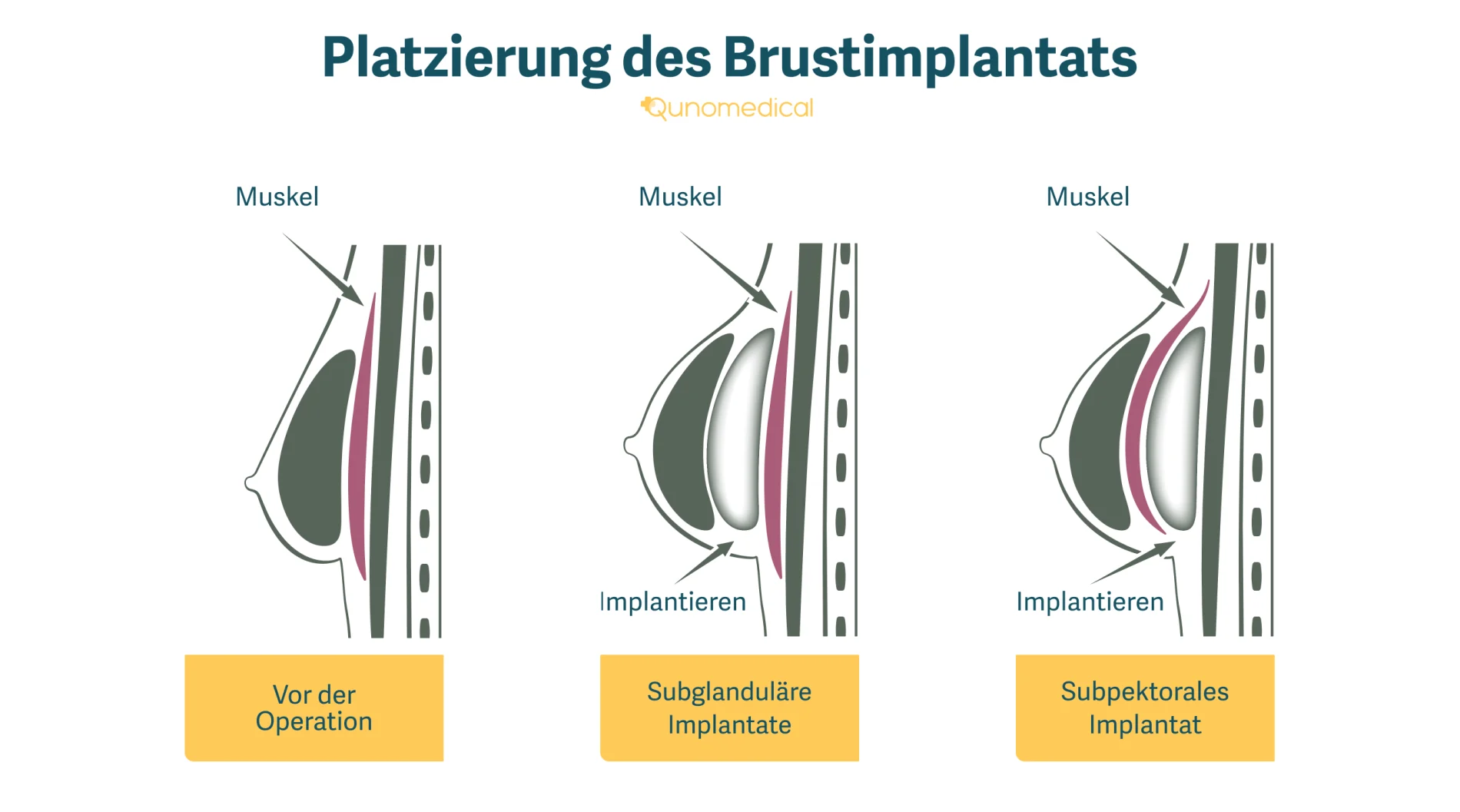 Diagramm, das zeigt, wie ein Brustimplantat-Insertionsverfahren funktioniert.