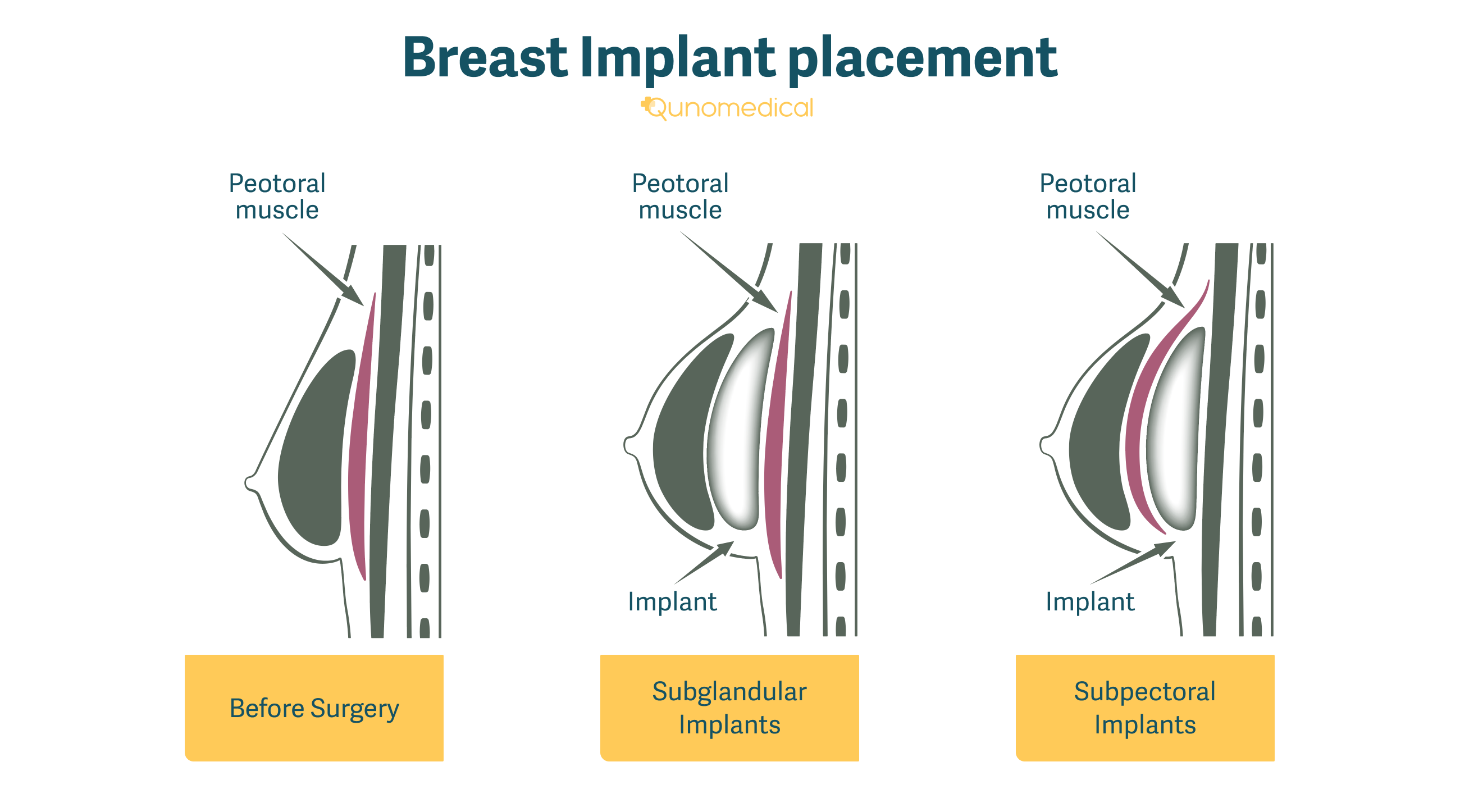 Teardrop Breast Implants: Say Hello to Perfect Breast Shape