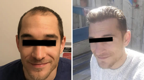 Mann zeigt lächelnd sein Haar vor und nach einer Haartransplantation.