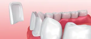 Schema der Anwendung einer Behandlung in der ästhetischen Zahnmedizin.