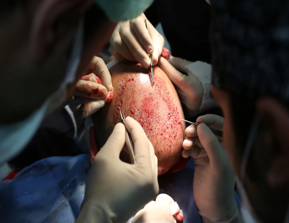 Haartransplantation: Schwestern und Spezialisten am Kopf eines Patienten