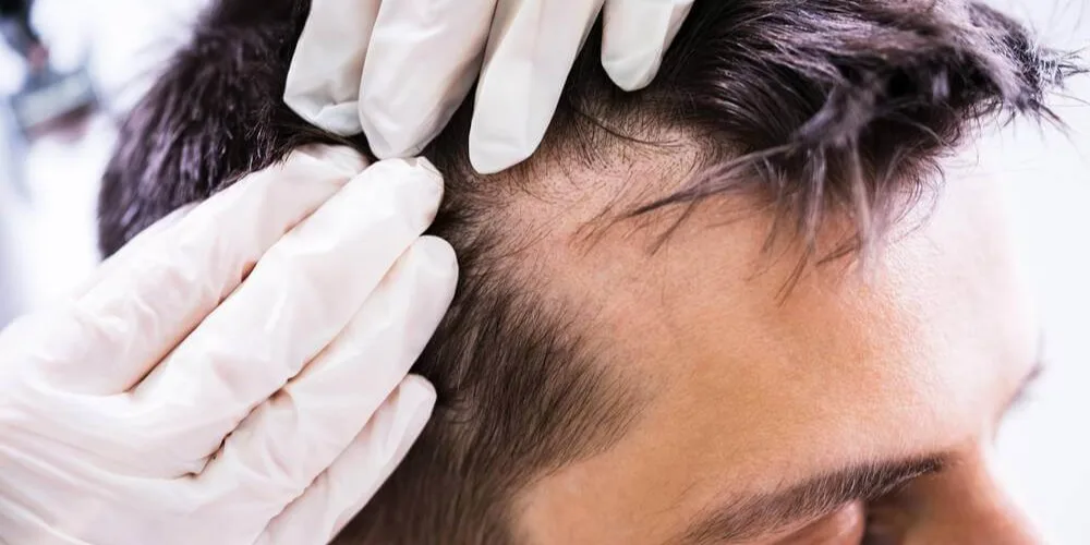 Dermatologe überprüft schwindenden Haaransatz