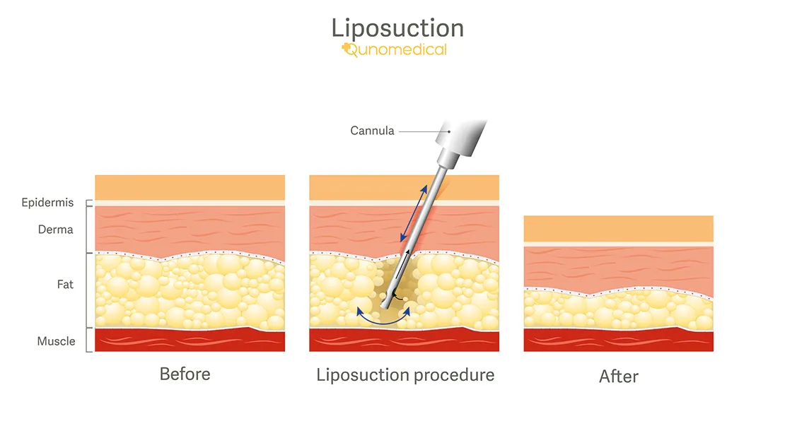 Liposuction Process Liposuction Surgery - At Home & Abroad | Qunomedical