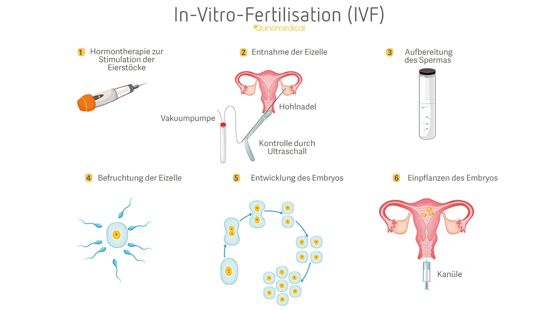 IVF-ablauf-zyklus jstz5i
