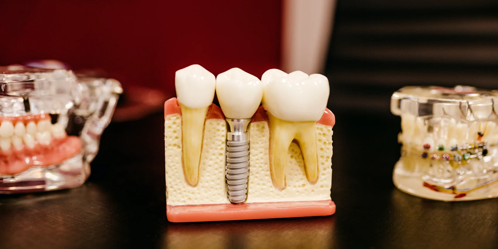Blog_free-dental-implants-UK_image