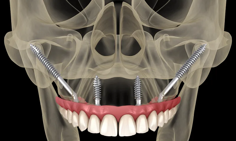 Zygoma Implantat Illustration
