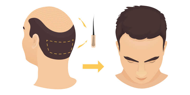 Illustration montrant le résultat final après une procédure de greffe de cheveux.